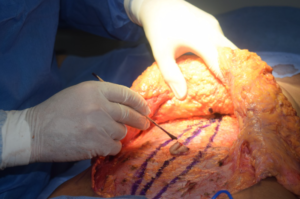 Tummy Tuck